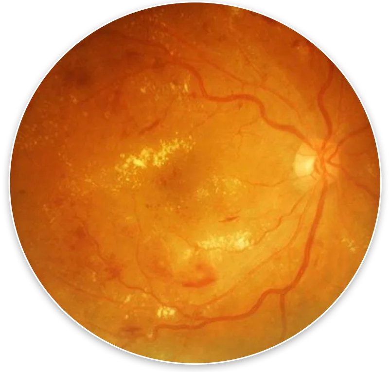Eye surgery patient recovering at Sahu Eye Hospital, Mumbai