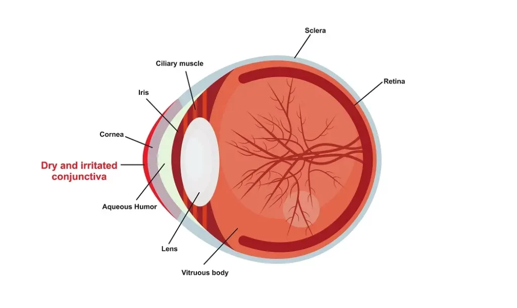 Medical cross-section illustration showing dry eye syndrome and tear ducts