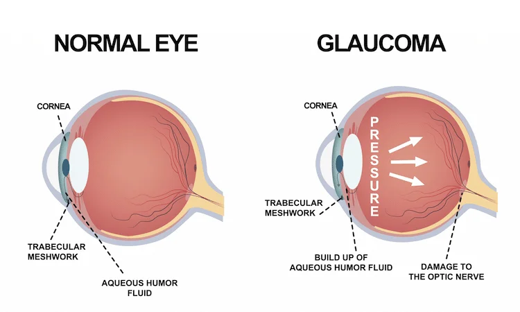 Medical illustration comparing normal eye versus glaucoma condition